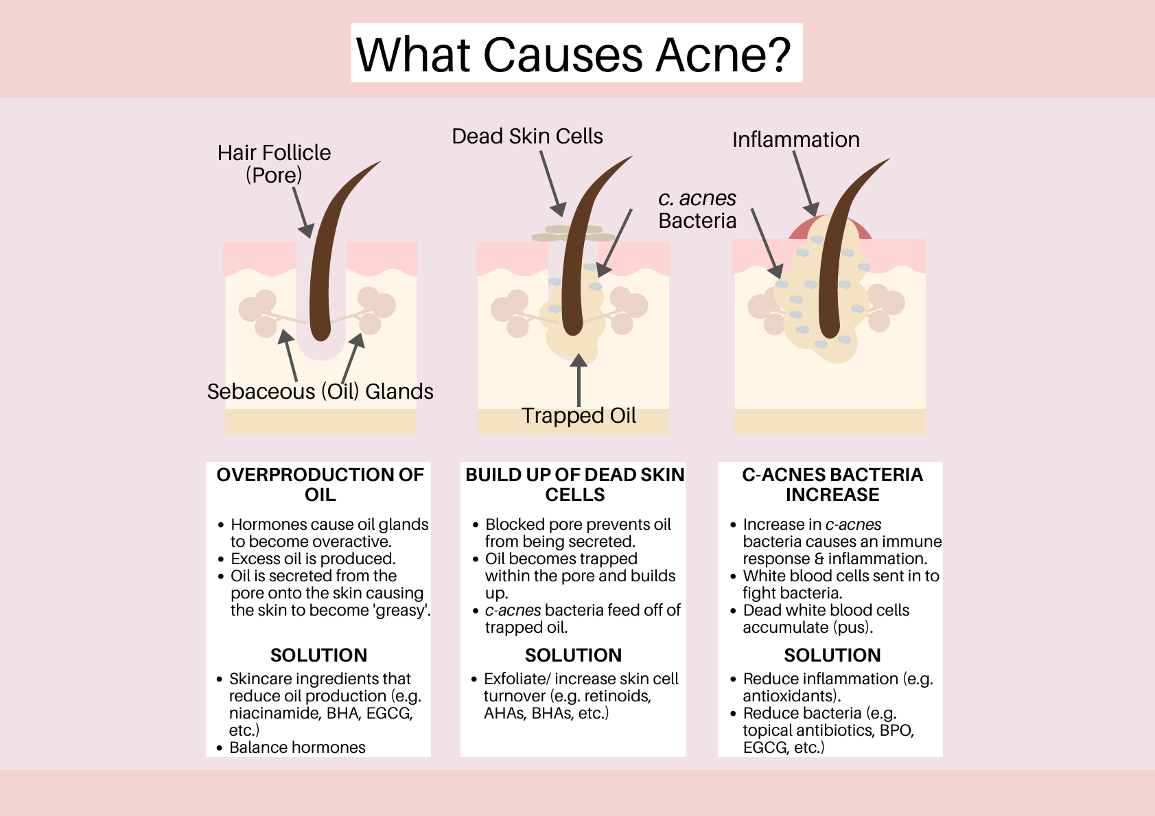 The Science of Acne: Real Causes and How to Treat It