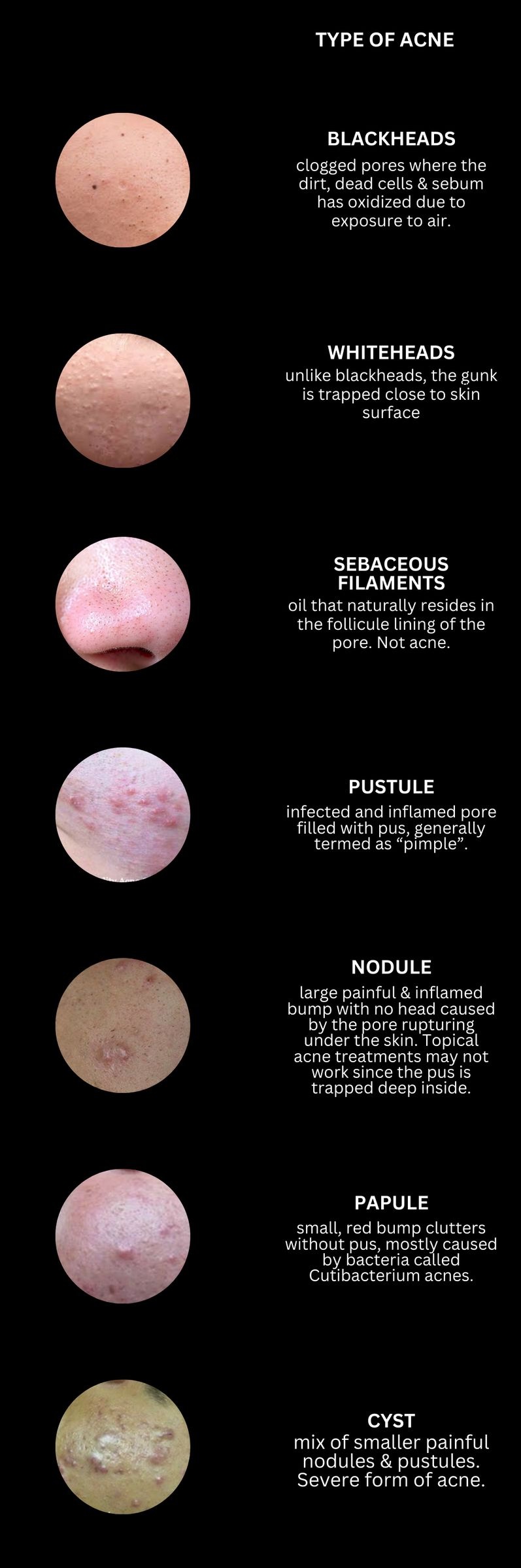 acne types